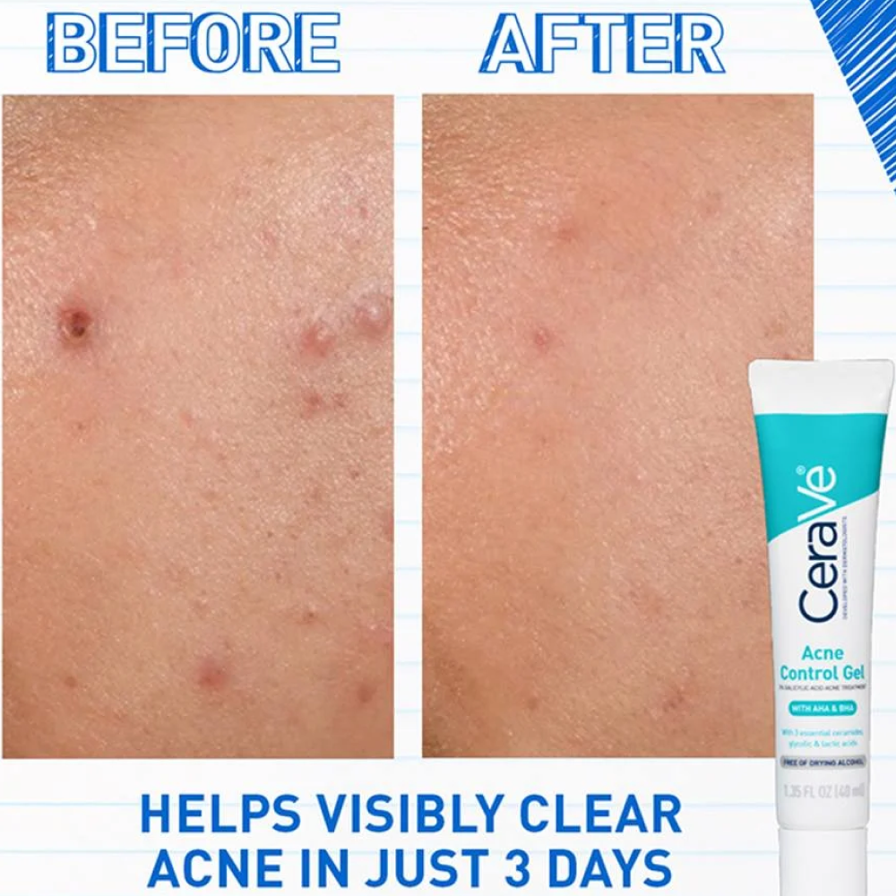 Cerave Acne Control Gel 40ml-Exfoliator-Beauty and hair supply