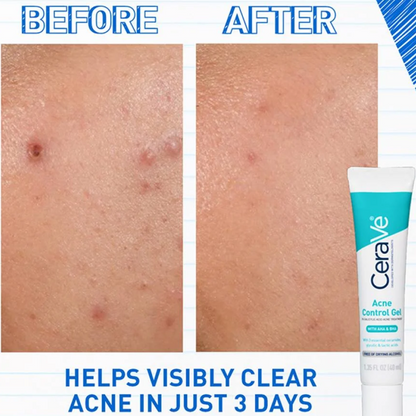 Cerave Acne Control Gel 40ml-Exfoliator-Beauty and hair supply